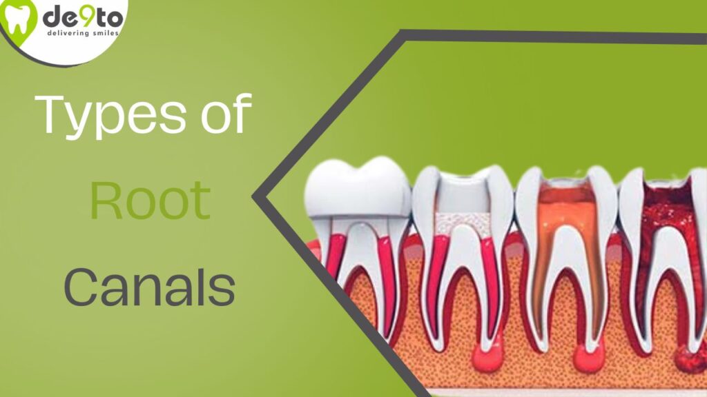 Exploring the Different Types of Root Canals